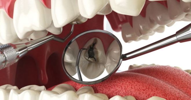 Пульпит зуба – причины и современное лечение