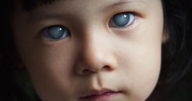 Синдром Аксенфельда-Ригера – можно ли сохранить зрение ребенку?