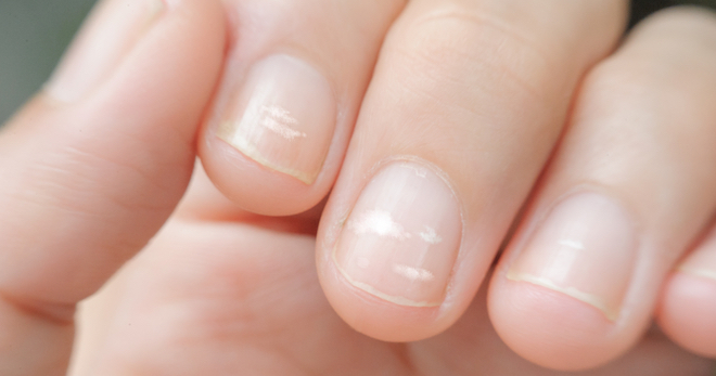 Белые полоски на ногтях – причины продольных и поперечных полос