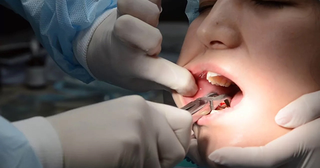 Удаление зуба мудрости на нижней челюсти – как проходит операция, и что делать после?