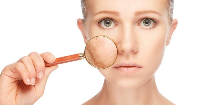 Пигментные пятна на лице – как избавиться с помощью косметики и современных процедур?