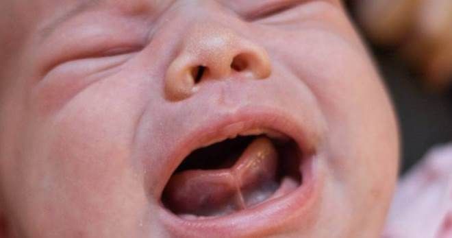 Как определить короткую уздечку языка у новорожденного ребенка признаки и упражнения для растяжки