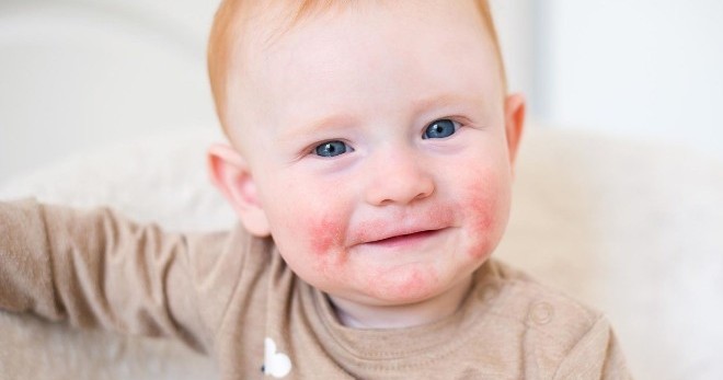 Аллергический дерматит у детей – что делать для лечения и профилактики?