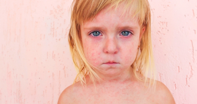 Розелла Детская Болезнь Фото И Симптомы