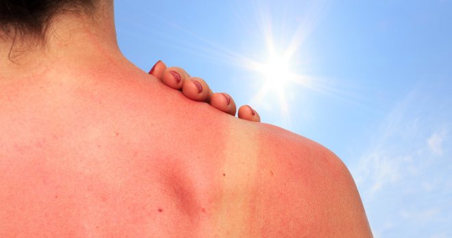 Солнечный дерматит – как быстро избавиться от фотодерматоза?