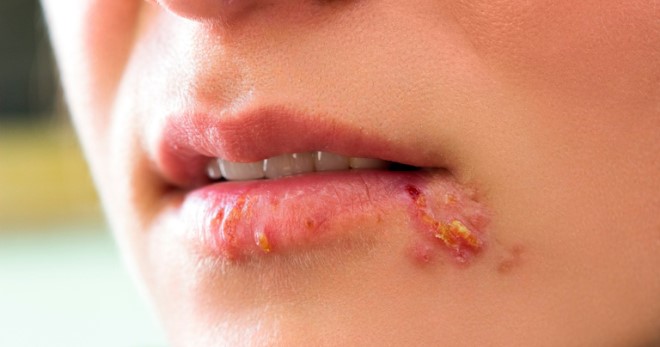 Герпес на губах — причины, которых можно избежать