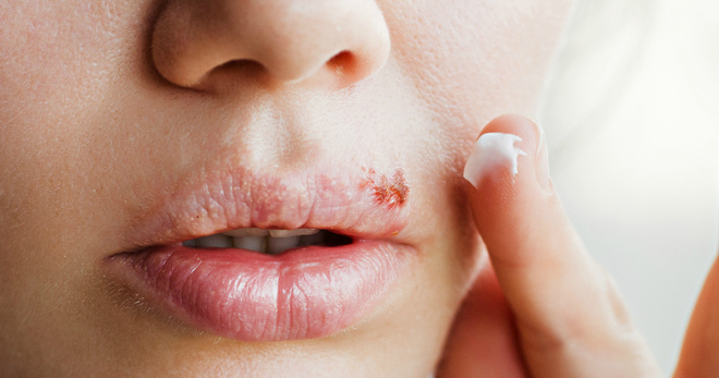 Простуда на губах – почему появляется, и как быстро избавиться от герпеса?
