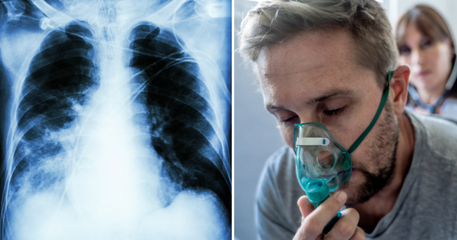 Пневмония без симптомов – как вовремя распознать угрожающую болезнь?