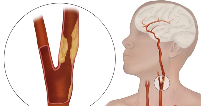 Стеноз сонной артерии – симптомы, лечение и последствия