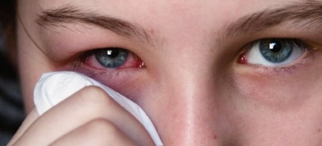 туберкулез глаз симптомы первые признаки