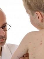 Диета при атопическом дерматите у детей