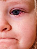Покраснел глаз у ребенка – что делать?