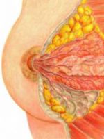 Внутрипротоковая папиллома молочной железы - причины, симптомы и лечение