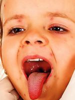 Как лечить герпес в горле у ребенка?