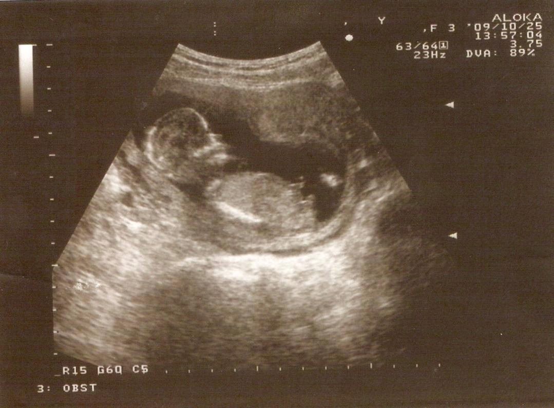 Как Выглядит 6 Недель Беременности Фото