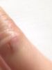 Трещина на пальце руки – симптомы, причины, психосоматика