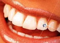 стразы на зубах 5
