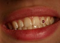 стразы на зубах 6