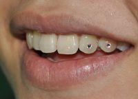стразы на зубах 9