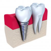Имплантация зубов противопоказания и возможные осложнения