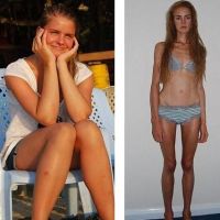 анорексия до и после5
