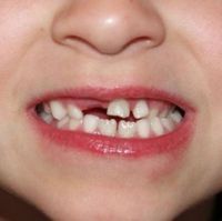сроки прорезывания постоянных зубов