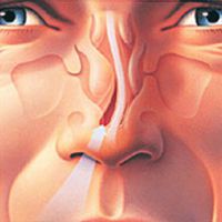 искривление перегородки носа лечение