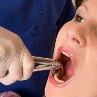 удаление корней зубов без боли