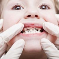 почему у детей чернеют молочные зубы