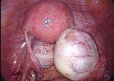 операция кистома правого яичника