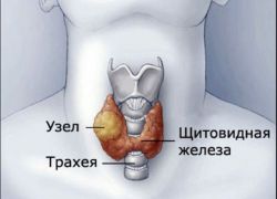 узелки щитовидной железы
