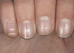 White horizontal stripes on nails