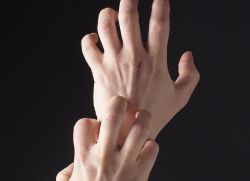 дисгидротическая экзема кистей рук