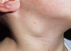 воспаление лимфоузлов на шее у ребенка причины