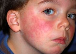 Симптомы аллергии у детей