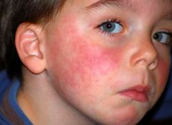 аллергический дерматит у детей лечение