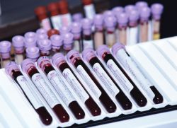 анализ крови при онкологии