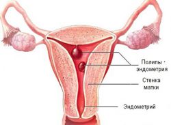 беременность и полип эндометрия