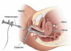 биопсия эндометрия
