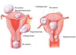 Фиброма матки симптомы и лечение