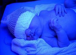 физиологическая желтуха новорожденных лечение