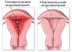 Гиперплазия эндометрия