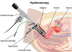 гистероскопия последствия