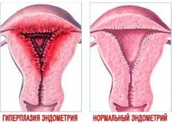 Методы лечения гиперплазии эндометрия