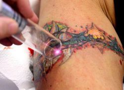 средство для выведения татуировок