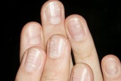 почему ногти становятся волнистыми