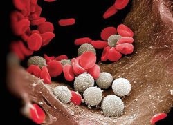 Причины лейкоцитоза в крови