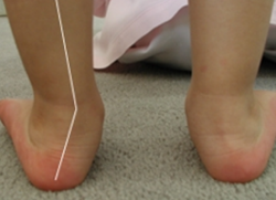 вальгусная деформация стопы у детей