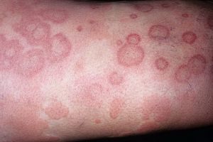 как выглядит аллергия на коже