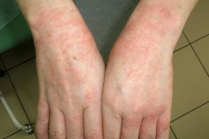 как выглядит аллергия на руках